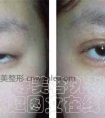 开眼角会使眼睛大吗?