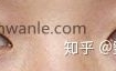 开眼角整容手术恢复期是多久?