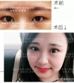 开眼角后会回缩,开了也白开?其实有办法。