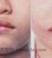 口角歪斜怎么办? 去美莱整形