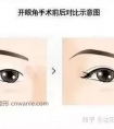 开眼角应该注意什么?如何恢复快!