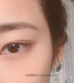 埋线双眼皮好,为什么大家还选择切开式呢?