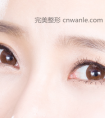 上海开眼角手术需要多次时间才能恢复