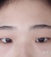 千万别轻易开内眼角,小心疤痕增生!
