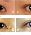 内眦赘皮矫正术会让眼睛变大吗
