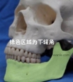 手术后感觉下巴和口角麻麻的,怎么办?很多姑娘面诊的