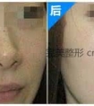 激光祛痣,无疤更