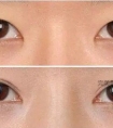 开眼角手术开大了,可以修复缩小吗?