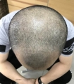 临沂纹发际线机构之纹发会不会出血