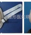 小耳畸形术后再造的耳朵和胸部伤口如何护理?