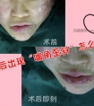 吸脂损伤面神经后出现“嘴角歪斜”怎么办?
