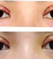 双眼皮+开眼角术后恢复期到底有多长?很多做了双眼皮