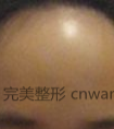 纹发际线效果能够维持多久