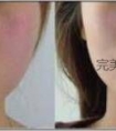 伊莱美厚唇改薄手术怎么样?