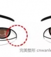 双眼皮应该怎么割,肿泡眼、不对称、上睑下垂双眼皮和开眼角手术一起做啊!