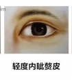 医生为何建议你,双眼皮和开眼角一起做?