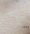 怎样改善皮肤,拯救毛孔粗大?