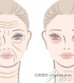 北京联合丽格医生陈翠云告诉你额头怎么去皱纹效果好?