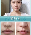 媚唇术【真实案例分享】↓↓↓