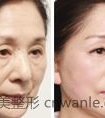 激光除皱功效有哪些