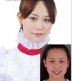 像素激光去皱的优势有哪些