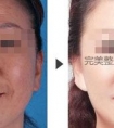 吉林市铭医激光除皱有什么好处?