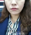 用我的亲身经历告诉你激光去皱纹价格和效果能保持多久