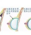假体隆胸后多久需要取出假体?