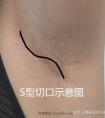 假体隆胸哪个好看,切口会不会被发现?
