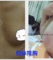 假体隆胸手术通过假体填充的方式来达到丰胸效果,效果