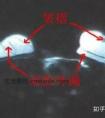 假体隆胸手术后多久需要取出?