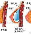 自体脂肪隆胸和假体隆胸原理和本质区别?