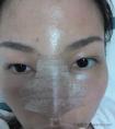 广州海峡硅胶假体隆鼻真实案例分享,鼻子垫高了4毫米