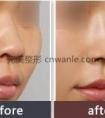 硅胶隆鼻,你想知道的都在这里,价格多少钱?