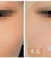 假体隆鼻,失败了怎么办?