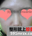 假体隆鼻恢复经历 假体隆鼻后恢复过程图