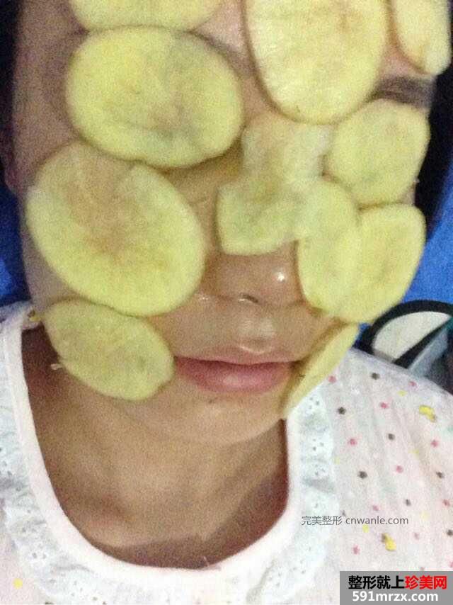 假体隆鼻手术多少钱