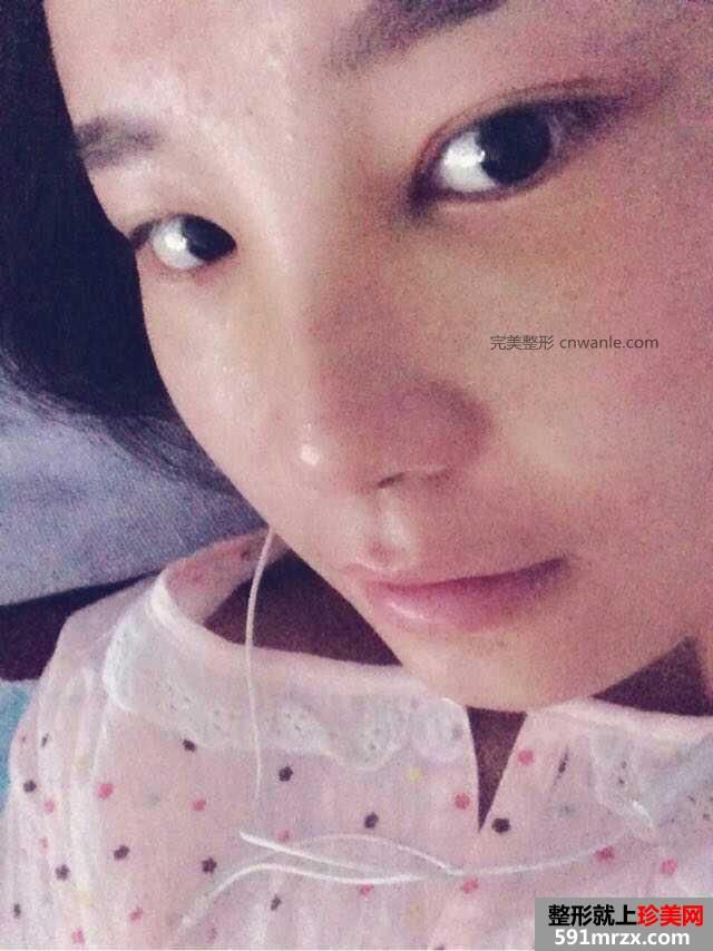 假体隆鼻手术多少钱