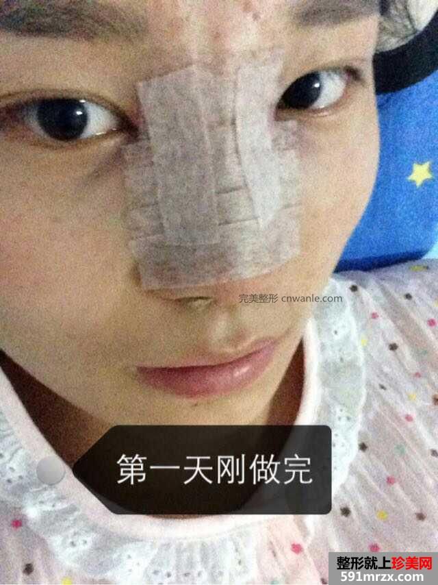 假体隆鼻手术多少钱