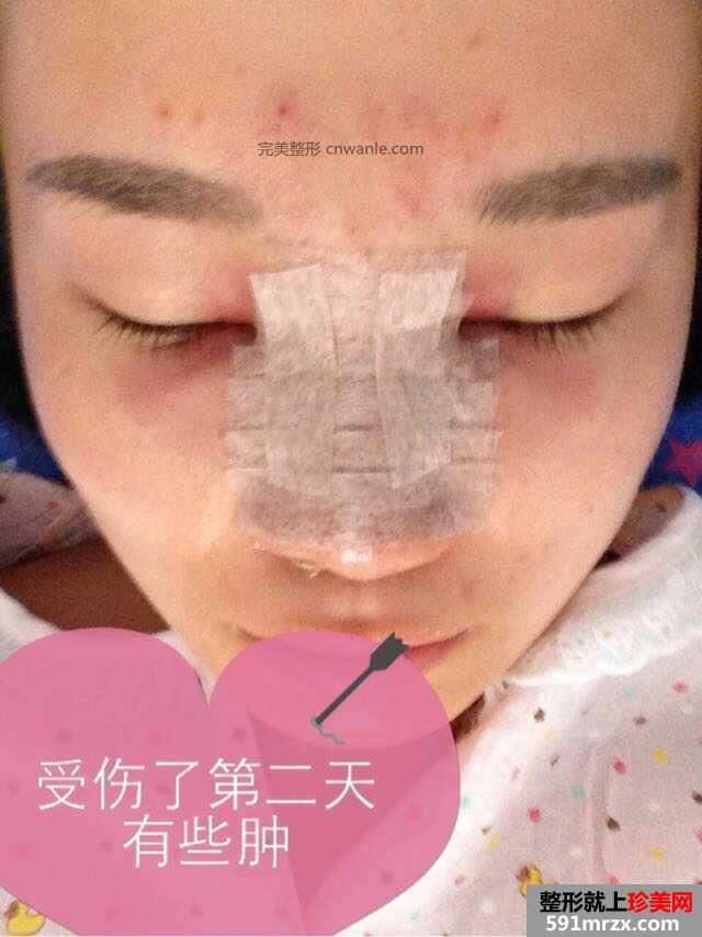 假体隆鼻手术多少钱