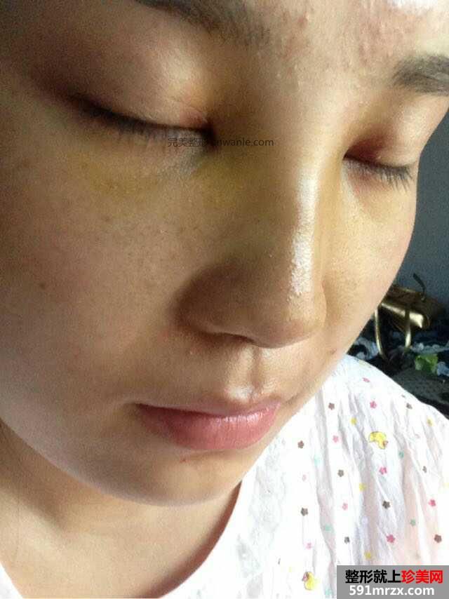 假体隆鼻手术多少钱