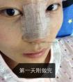假体隆鼻手术大概需要多少钱 我来告诉你