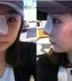 假体隆鼻真实案例分享:路人到女神的转变或许只差一个鼻子