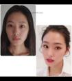 隆鼻之后鼻孔外露?像个佩奇?该怎么办?不少求美者说