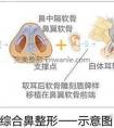 隆鼻有什么后遗症吗,最好是采用哪种隆鼻方式效果好?