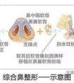 什么是鼻综合?和传统假体隆鼻相比有什么区别?