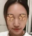 假体隆鼻要求自然 拒绝网红鼻 恢复后没有异物感好评