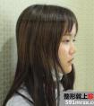 长沙美研孔伟立假体隆鼻案例效果对比图恢复过程分享~