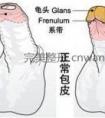 包皮过长对男性有哪些危害的介绍