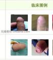 包皮过长的危害来自5个方面